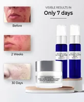 Bionova Acne + Acne Scar Discovery Collection with Uv Chromophores