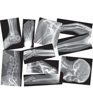 Roylco 15ct Broken Bones X Rays