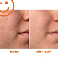 ExfoliKate™ Intensive Exfoliating Treatment