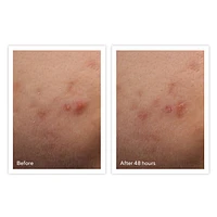Rapid Relief Acne Spot Treatment