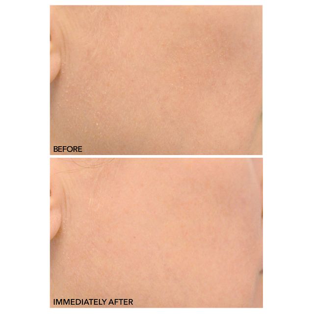 Alpha Beta™ Advanced Liquid Peel