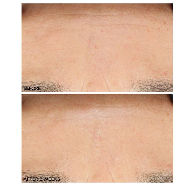 Alpha Beta™ Advanced Liquid Peel