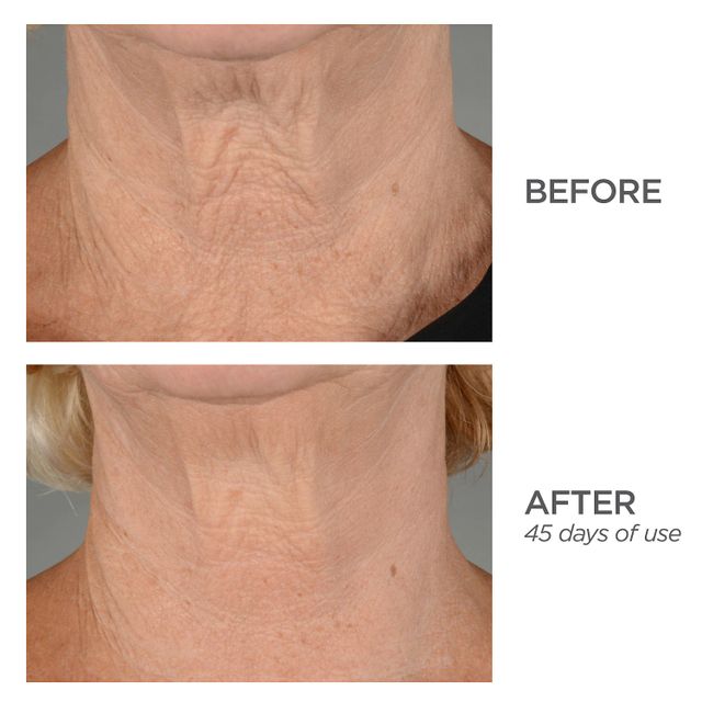 R45 The Lift 3-Phase Advanced Neck Contouring Treatment