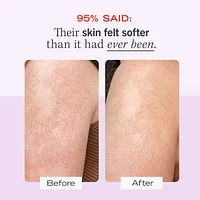 KP Bump Eraser Body Scrub with 10% AHA – Exfoliant for Keratosis Pilaris