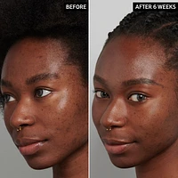 Tranexamic Acid Hyperpigmentation Treatment