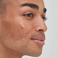 Tranexamic Acid Hyperpigmentation Treatment