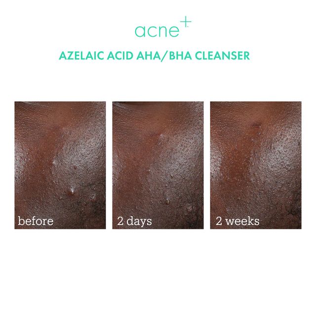 Acne+ 2% BHA + Azelaic Acid + Niacinamide + AHA Cleanser