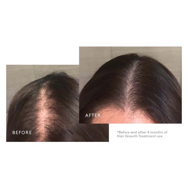 Flourish® Hair Growth Treatment Set with Minoxidil