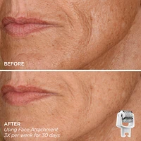 Eye Want It All Face + Eye Microneedling Set