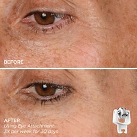 Eye Want It All Face + Eye Microneedling Set