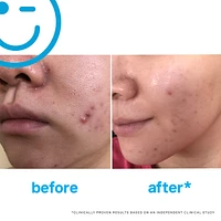 EradiKate™ 3% Sulfur Daily Foaming Cleanser + Acne Treatment