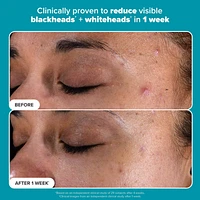 Skin Perfecting 2% BHA Exfoliating Toner for Clear