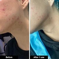 Pimple Paste Overnight Blemish Spot Treatment