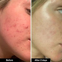 Pimple Paste Overnight Blemish Spot Treatment