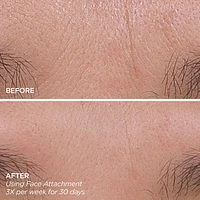 Get That Glow - GloPRO® Microneedling Tool & Discovery Set
