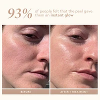 Triple Acid Signature Peel