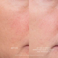 Equilibrium Resurfacing Retinoid Treatment