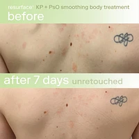 KP+ Psoriasis Smoothing Treatment Body Lotion