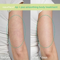 KP+ Psoriasis Smoothing Treatment Body Lotion