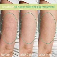 KP+ Psoriasis Smoothing Treatment Body Lotion