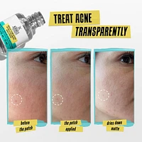 Truly Targeted Acne-Clearing Salicylic Acid Pimple Patch 