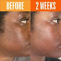 UNSPOTTED 4X Dark Spot + Hyperpigmentation AHA Serum