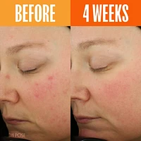 UNSPOTTED 4X Dark Spot + Hyperpigmentation AHA Serum