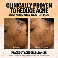 2% Salicylic Acid Acne Gel Cleanser
