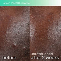 acne+ triple threat set with Salicylic Acid (BHA) + Niacinamide with B-L3™