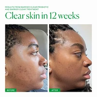 Barrier Clear Blemish Treatment