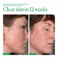 Barrier Clear Blemish Treatment