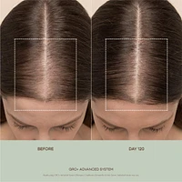 GRO+ Advanced Hair Serum for Severe Signs of Thinning