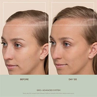 GRO+ Advanced Hair Serum for Severe Signs of Thinning