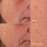 Even Better Clinical™ Dark Spot Clearing Serum with Vitamin C
