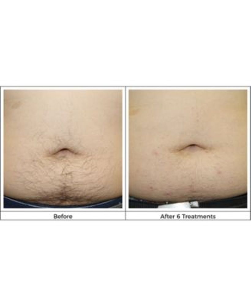 Silk'N Infinity Hair Removal Device Mall of America®