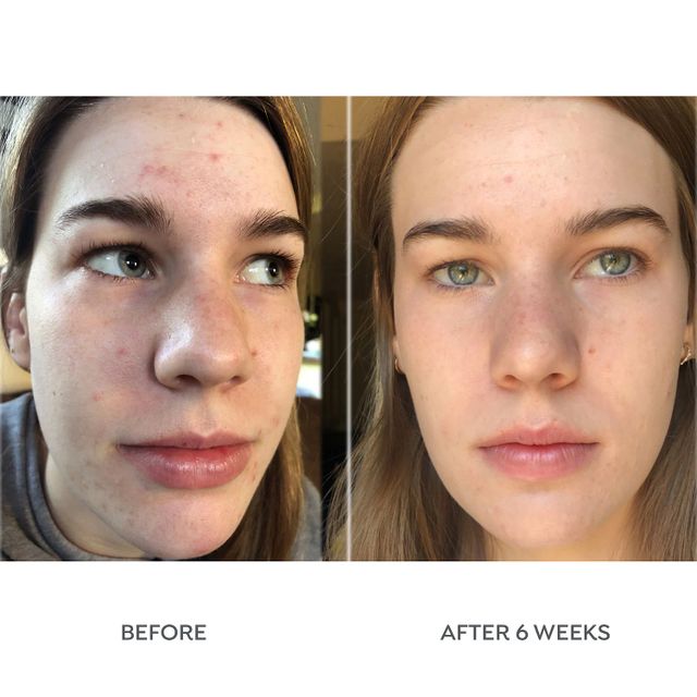 Dr. Zenovia Skincare 10 Benzoyl Peroxide Acne Cleanser Mall of America®