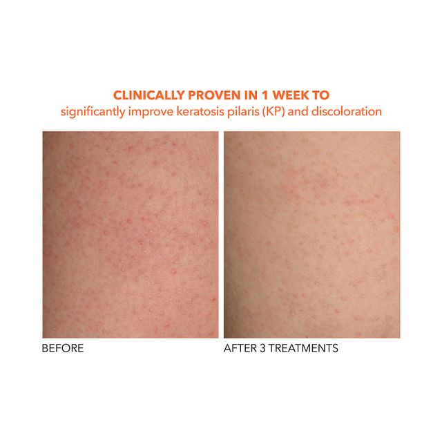 Dr. Dennis Gross Skincare Alpha Beta® Exfoliating Body Treatment Peel