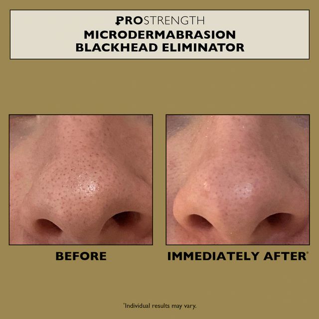 Peter Thomas Roth PRO Strength Microdermabrasion Blackhead Eliminator