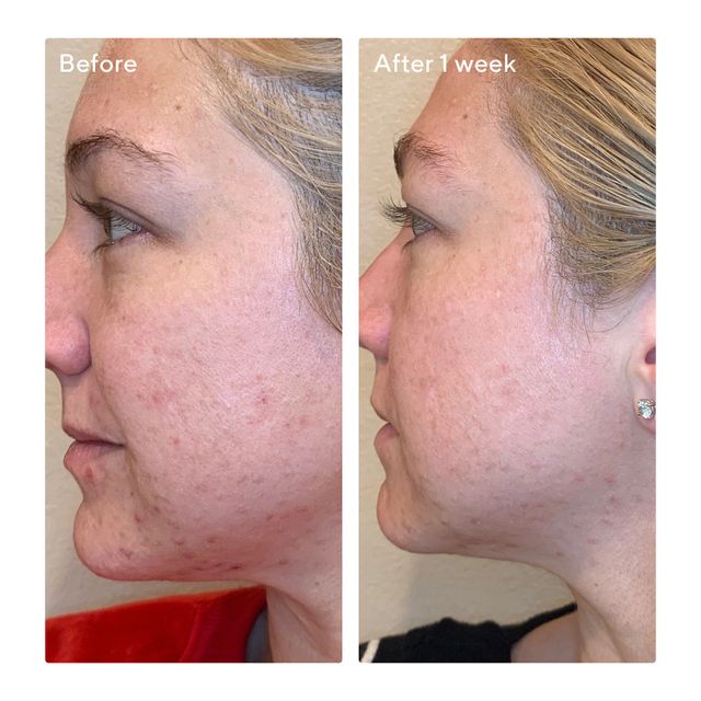 Murad AHA/BHA/Retinoid Daily Clarifying Peel Mall of America®