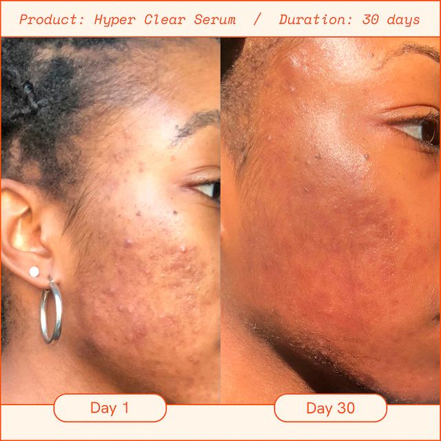 Hyper Skin Brightening Dark Spot Vitamin C Serum Mall of America®